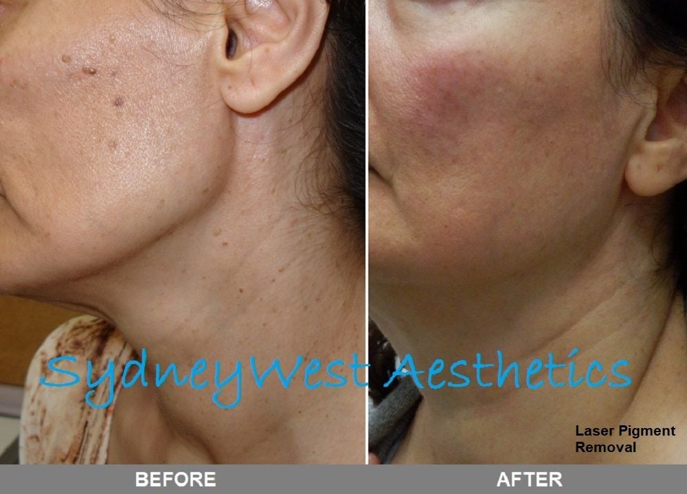 Pigmentation Image -5c8095ed07875